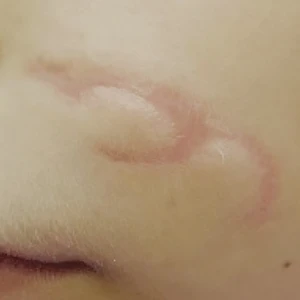 blizna